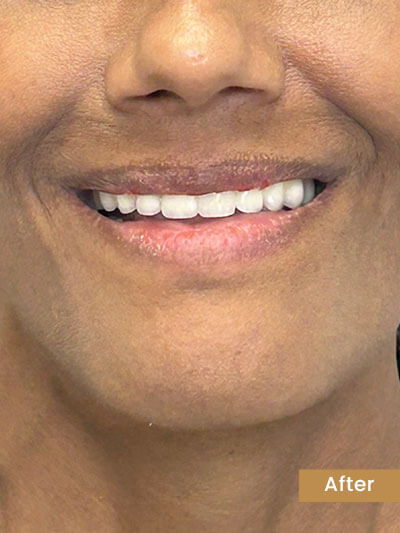 After treatment