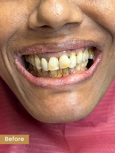 Before treatment