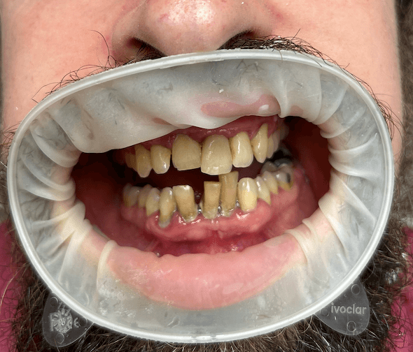 Before treatment